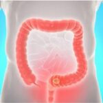 Colorectal cancer : अगर दिख रहे हैं यह पांच लक्षण तो हो जाए सतर्क, आंतों के इस कैंसर के संकेतो को ना करें नजर अंदाज, दुनिया मे तेज़ी से फैलने वालो मे है ये कैंसर