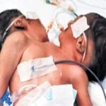 मां पर टूटा दुखों का पहाड़… दो सिर और एक धड़ वाले दुर्लभ जुड़वां बच्चों का निधन